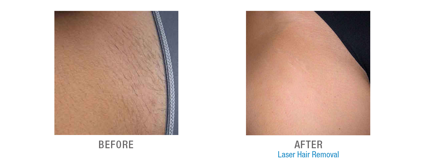 Is the Use of IPL Laser Hair Removal Machine Safe during Pregnancy   Skingen IPL Hair Laser Removal Device in Pakistan